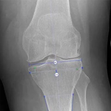 OrthoView SmartKnee planning tutorial