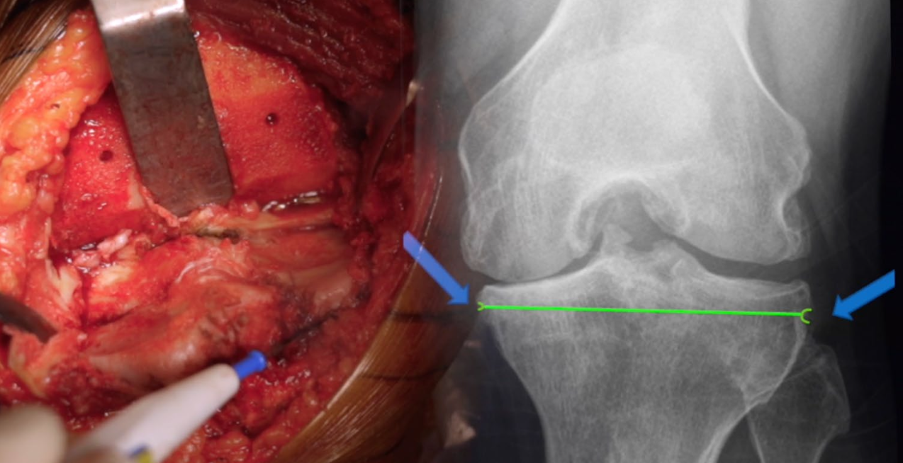 Intraoperative tibial landmark marking alongside an AP knee radiograph, with blue arrows indicating the medial and lateral reference sites joined by a green line across the proximal tibia.