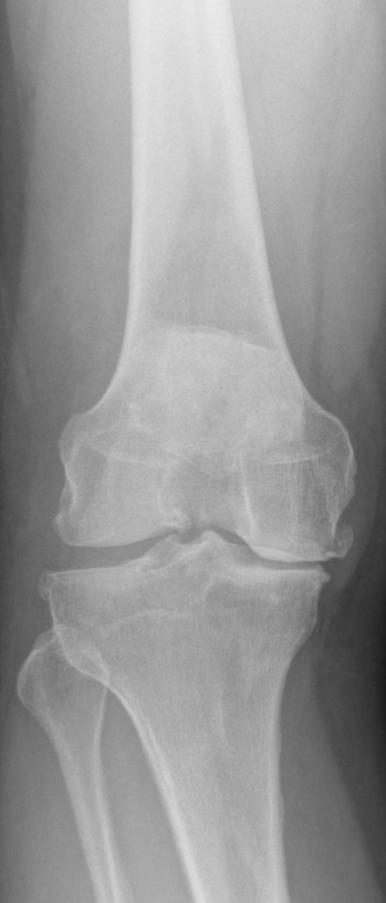 Example front-view knee X-ray